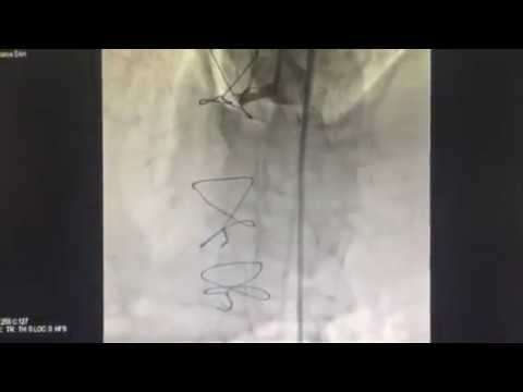 RCA-CTO; Retrograde ipsilateral approach and R-CART and Ping-pong technique