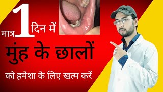 एक दिन में मुंह के छाले गायब । मुंह के छालों (Mouth Ulcers) का घरेलू उपचार | mouth Ulcers treatment