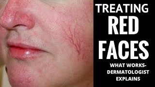 How to treat red faces