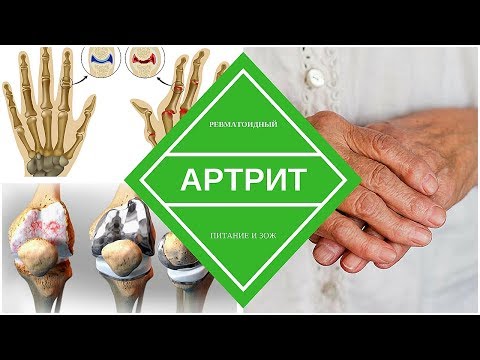 Боли справа при вдохе лежа на спине Артрит заболевание височно-нижнечелюстного сустава