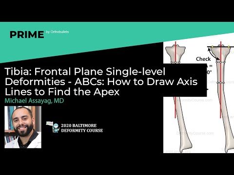 Tibia: Frontal Plane Single-level Deformities - ABCs - Michael Assayag, MD