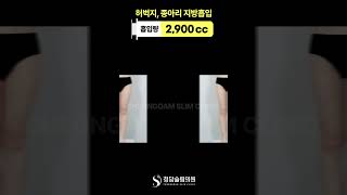 모두가 궁금했던 종아리 지방흡입 전후