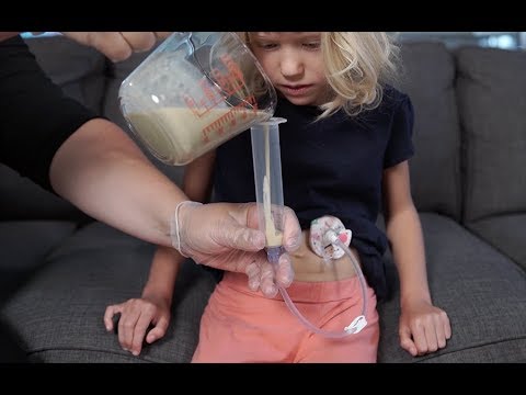 Bolus Feeding by Syringe—Gravity Method