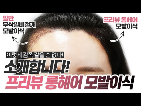 의느님답변????ㅣ비절개 방식으로 모발을 길게 뽑는 새로운 신기술!