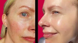 ROSACEA - How to calm & soothe skin