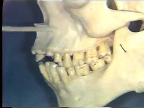 Nerve Supply to Teeth; Maxillary Sinus