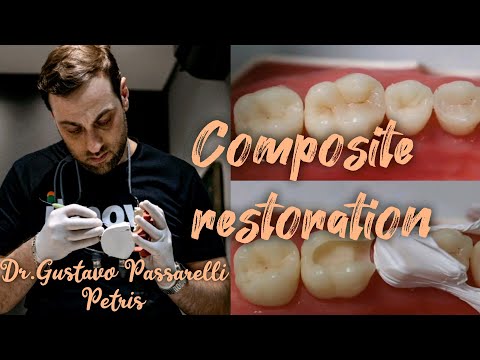 Odbudowa kompozytowa | Modelowanie anatomii zęba