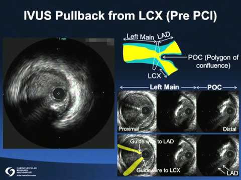 Left Main Bifurcation Lesion