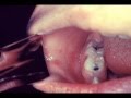 MEASLES rash ,symptoms and complication - YouTube