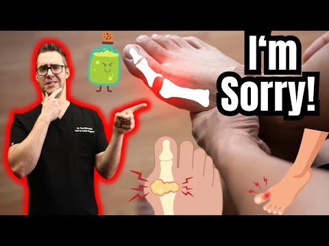 What is Gout TRUE Causes Treatments Symptoms Diet Diagnosis