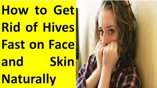 How to Get Rid of Hives Fast on Face Naturally