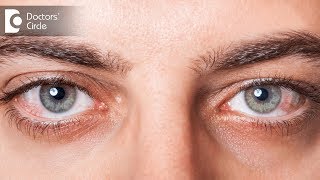 Causes of Red eye - Dr. Mala Suresh