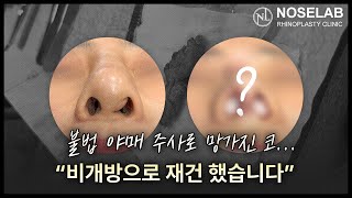 20년 된 불법 야매주사 제거와 비공 변형 교정 | 자가늑연골 재건 리얼 수술 후기