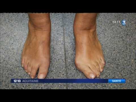 Big toe bolący guz szyna prostownica palucha koślawego korektor I uzdrowił palucha koślawego