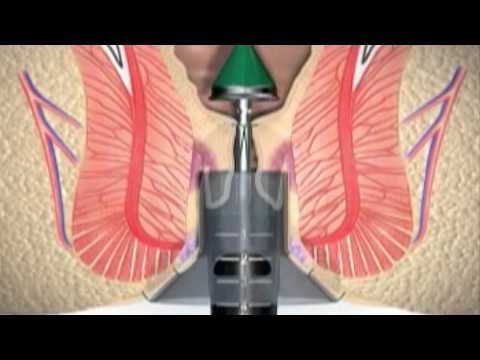 Op.Dr.Kadir Uskuay - What are the advantages of non-surgical hemorrhoid treatment?