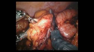Download Lagu Robotic right hemi colectomy with intra corporeal anastomosis by Dr. Iraniha Thumbnail