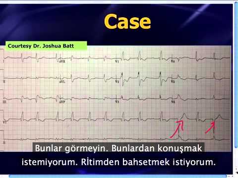 Mattu EKG Vakası -- Makine yorumuna güvenmeyin -- 23 Eylül 2013