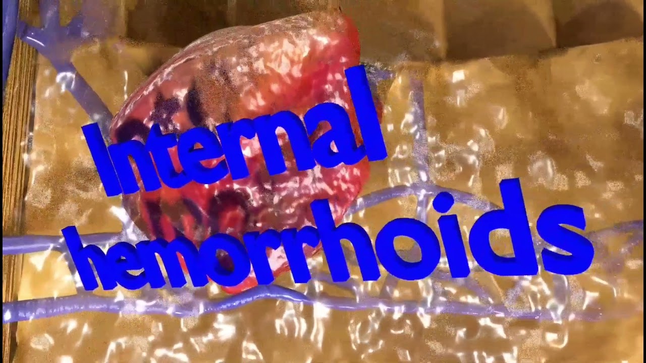 3D hemorrhoids CLEANED UP model 3D Model