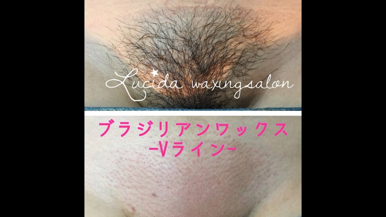 BrazilianWax~ブラジリアンワックス~Vライン【福岡天神ブラジリアンワックスLucida】