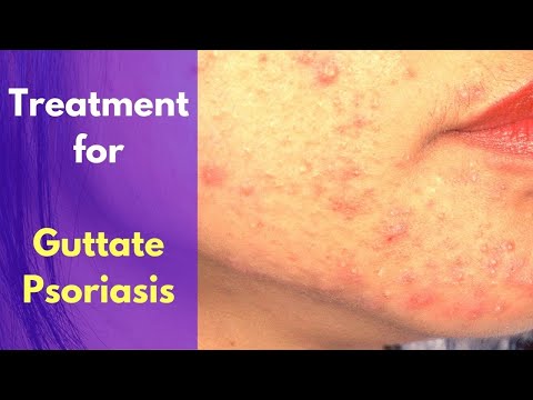 Psoriasis flare up on face