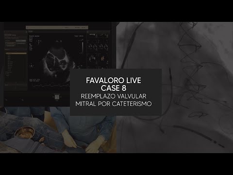 Favaloro Live Case N° 8 - Reemplazo Valvular Mitral por Cateterismo