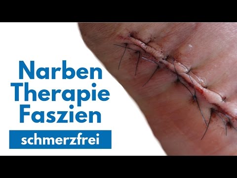 Rückenschmerzen mit Radikulopathie Wie man loswerden von degenerativen Bandscheibenerkrankungen der Brust