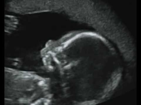 Fetal Medicine Foundation - Micrognathia