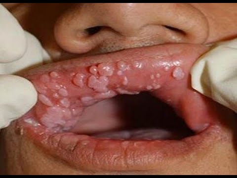 Hombres como humano en papiloma los es el