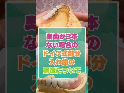 奥歯が3本ない場合のドイツ式部分入れ歯の構造について
