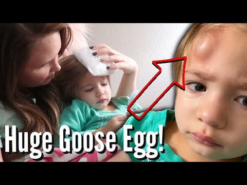 GIANT HEMATOMA ON TODDLER'S HEAD APPEARS AFTER PLAYING IN THE LOFT / TODDLER FORMS INSTANT GOOSE EGG