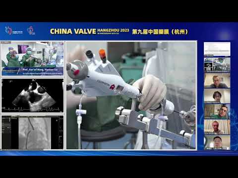 DragonFly for Functional Mitral Regurgitation