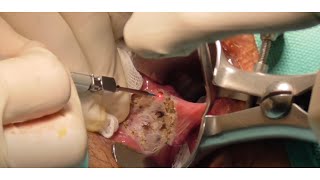 Cirugía Hemorroidal Laser - Hemorrhoid LASER procedure