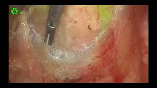 Asvide: Fluorescent laparoscopy-assisted radical resection of rectal cancer (Dixon procedure).