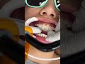 How Braces are Put On