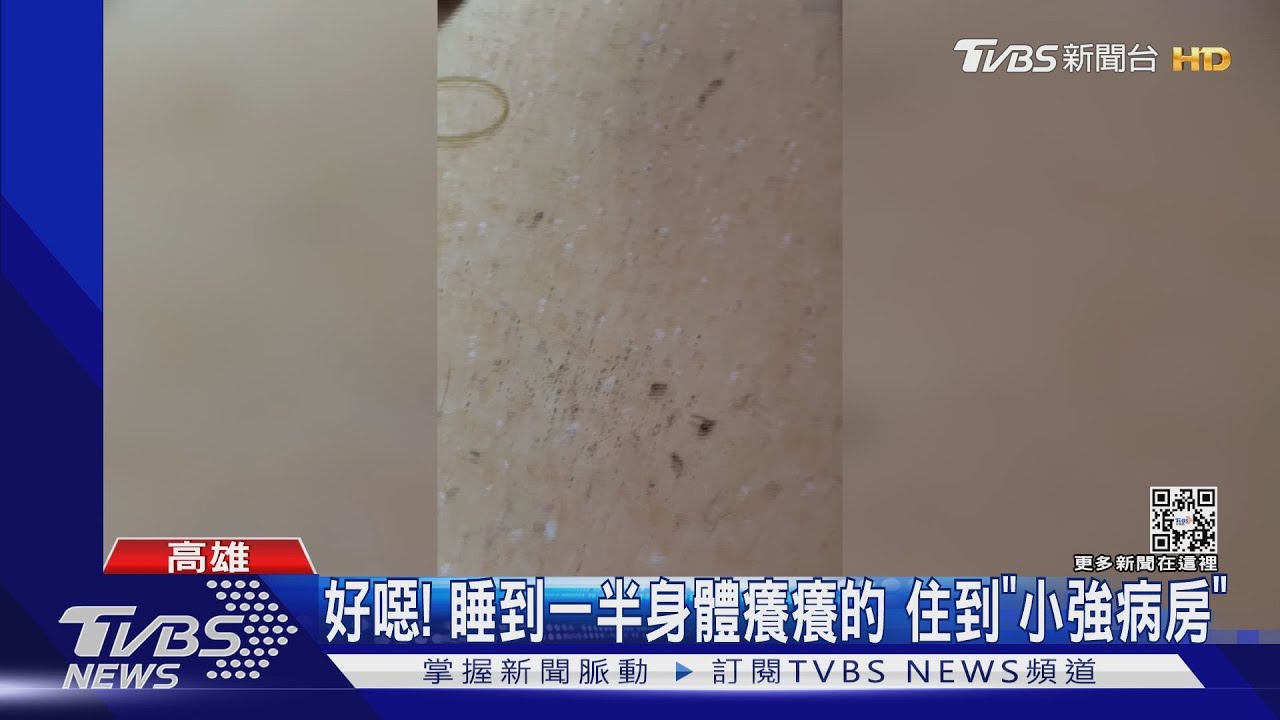 也太噁...小強大軍來襲! 病患睡到一半蟑螂爬臉