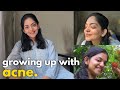 Growing Up With Acne Ahaana Krishna