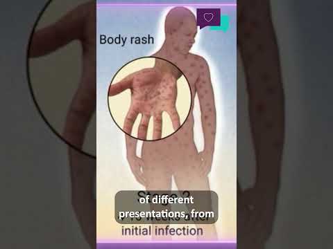 What are the signs of syphilis?