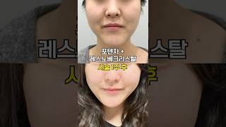 5세대 스킨부스터는 다르다