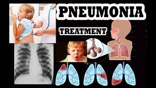 Pneumonia in children ( causes and treatment)