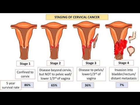 Klassifikation der zervikalen intraepithelialen Neoplasie; niedriggradige LSIL, hochgradige HSIL