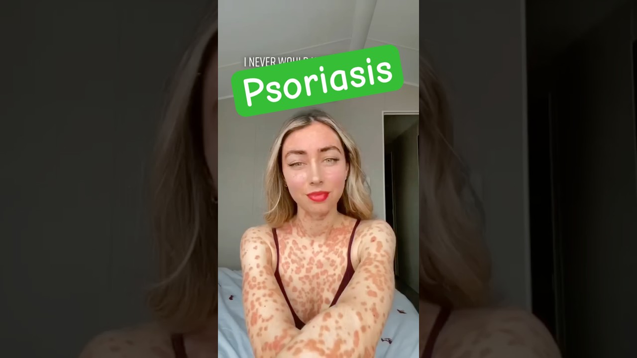 What Is Psoriasis #shorts