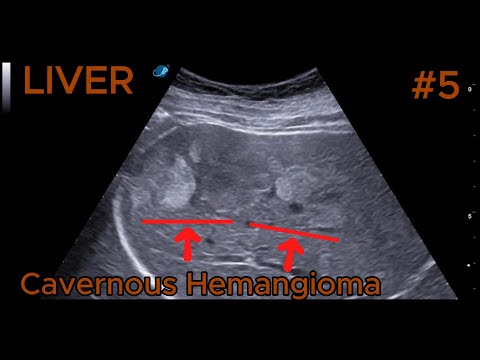 Cavernous Hemangioma - Iso-Hyperechoic, Trilobulated video preview
