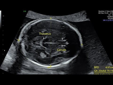 Landmarks, Measurements Of BPD