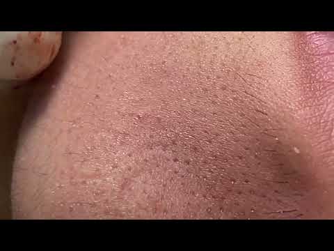 MERRY CHRISTMAS – ACNE BIG GIANT (His name is Tiến ) p7 – Acne Treatment Mai Ngoc