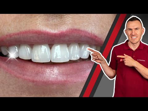 Frontzähne überkronen für Hollywood Smile? Vorher-Nachher Ergebnis nach Erneuerung von Zahnkronen!
