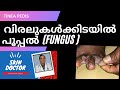 വിരലുകൾക്കിടയിൽ പൂപ്പൽബാധ ( fungus )/Tinea pedis/fungal toe infection/Dr