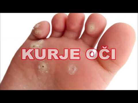 Kurje oči liječenje - NARODNA MEDICINA