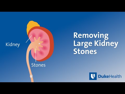 Removing Large Kidney Stones | Duke Health