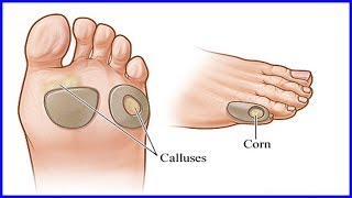 Remove Calluses On Feet  With 10 Effective Home Remedies