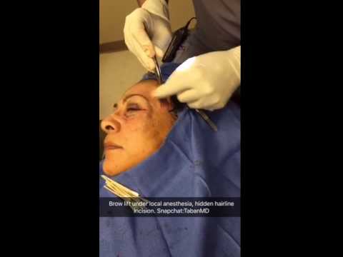 Pretrichial Brow Lift Using a Hidden Hairline Pretrichial Brow Lift Using a Hidden Hairline